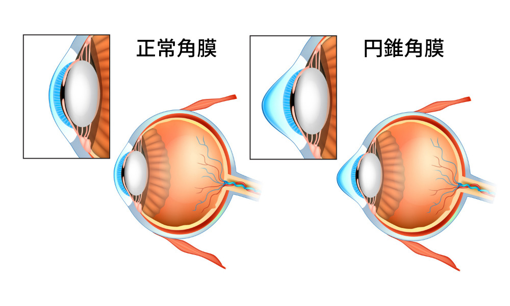 正常角膜と円錐角膜の比較