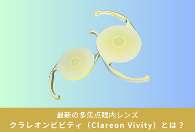 クラレオン ビビティ（Clareon Vivity）- 最新の多焦点眼内レンズ