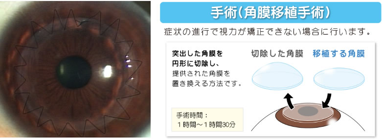 ステージ 3: 進行した円錐角膜