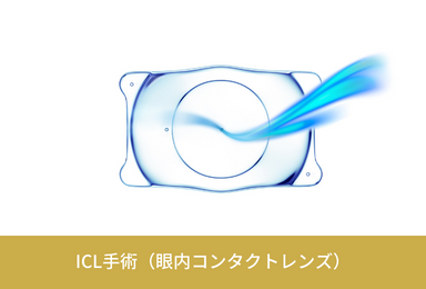 ICL手術（眼内コンタクトレンズ）