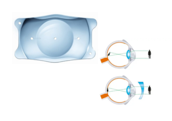 乱視用ICL-乱視の方のICL手術